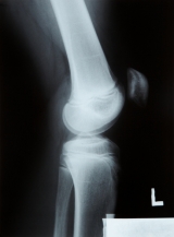 broken knees + ticks